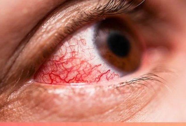 Number of viral conjunctivitis multiplying in Karachi