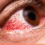 Number of viral conjunctivitis multiplying in Karachi