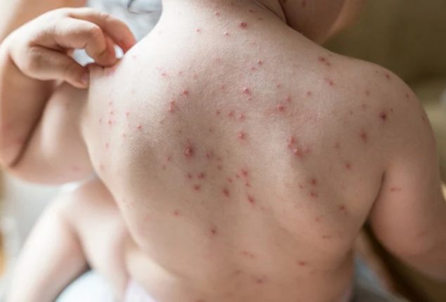 Emergency imposed in KP due to soaring chicken pox cases