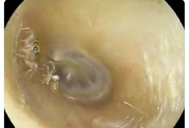 Spider in Ear