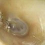 Woman Complains of ‘Abnormal Sounds’ Discovers Spider in Ear