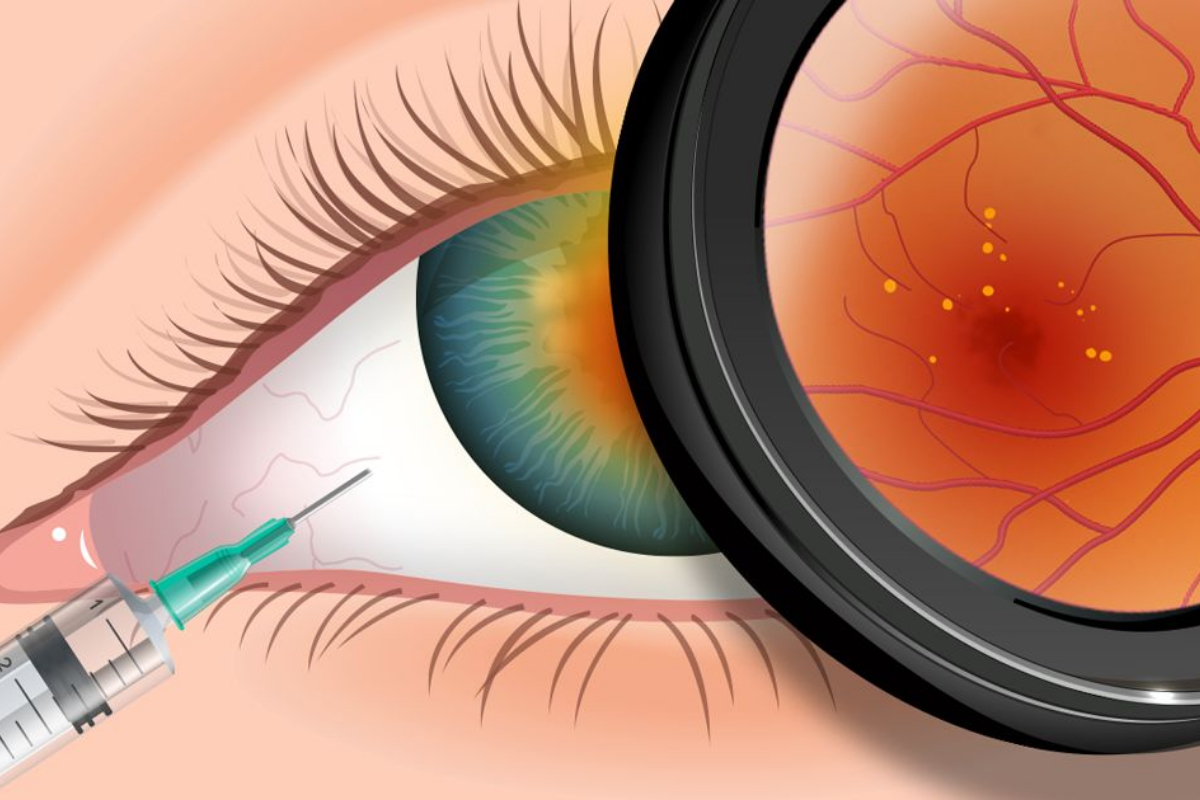 Avastin injection