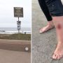 Surfer, 52, Shark-Bitten at Popular Tourist Beach