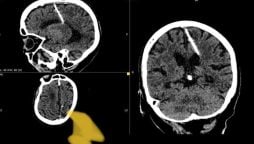 Russian doctors discover needle in woman’s brain in Sakhalin