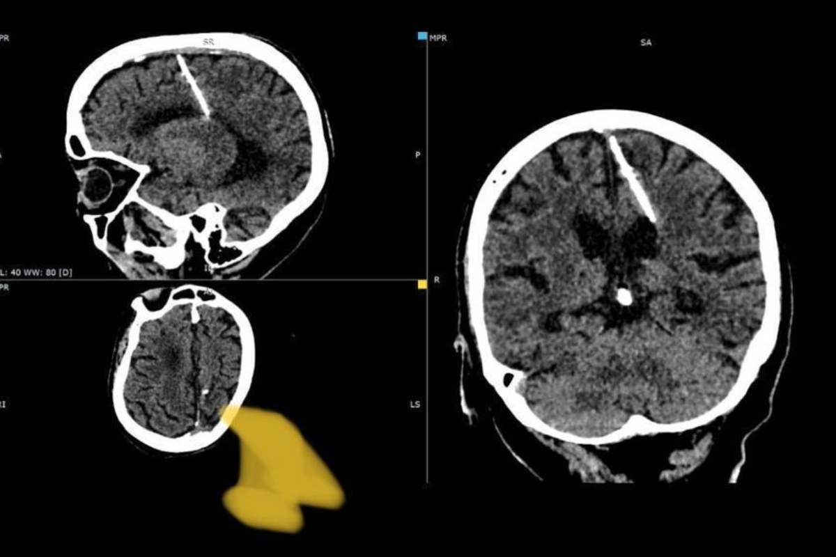 Russian doctors needle in woman's brain