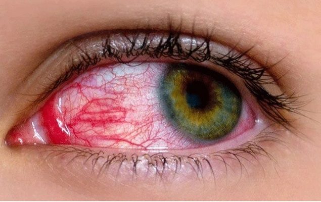 Use of antibiotics, steroids in conjunctivitis can affect eyesight: experts