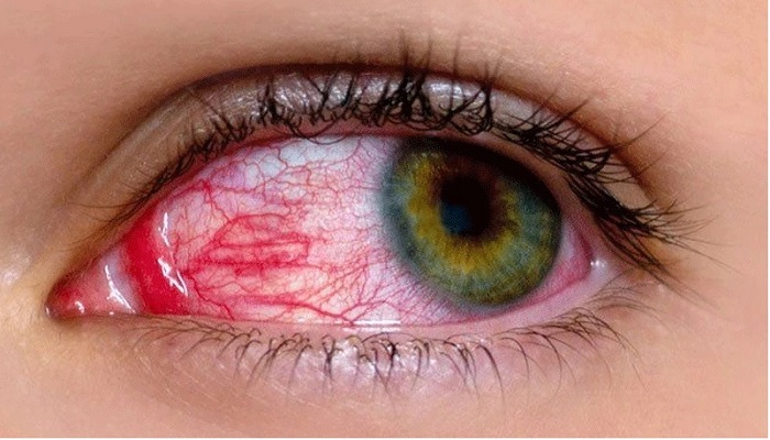Use of antibiotics, steroids in conjunctivitis can affect eyesight: experts