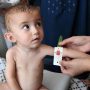 Interim Health Minister expresses resolve to deal with malnutrition