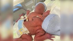 UAE: Mother Prays for Aid to Separate Conjoined Twins