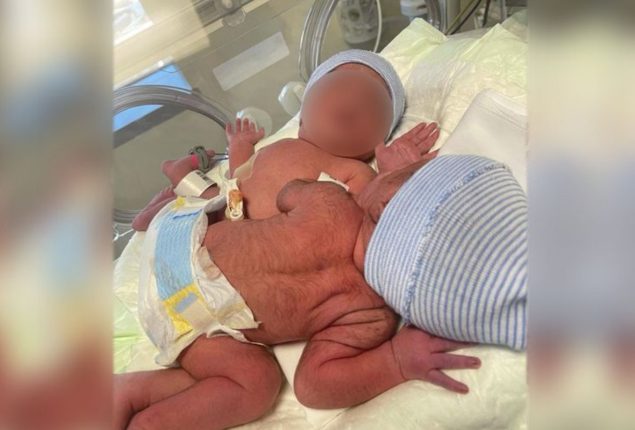 UAE: Mother Prays for Aid to Separate Conjoined Twins