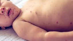 Measles claims lives of five children in Tando Allahyar