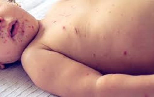 Five children died of measles on Sunday in Chandru Meo village of Tando Allahyar.