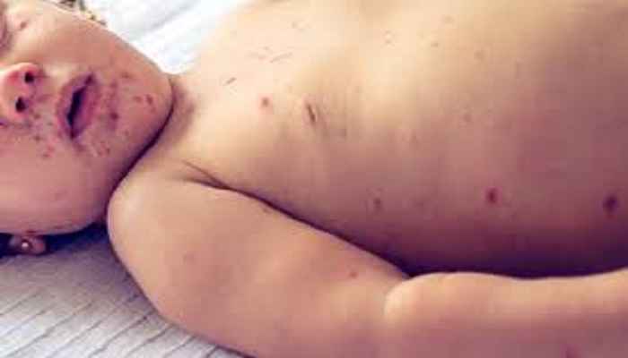 Five children died of measles on Sunday in Chandru Meo village of Tando Allahyar.