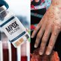 Alert; India reports first case of mpox
