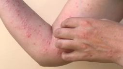 Pakistan confirms its first monkeypox case of 2024