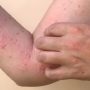 Pakistan confirms its first monkeypox case of 2024