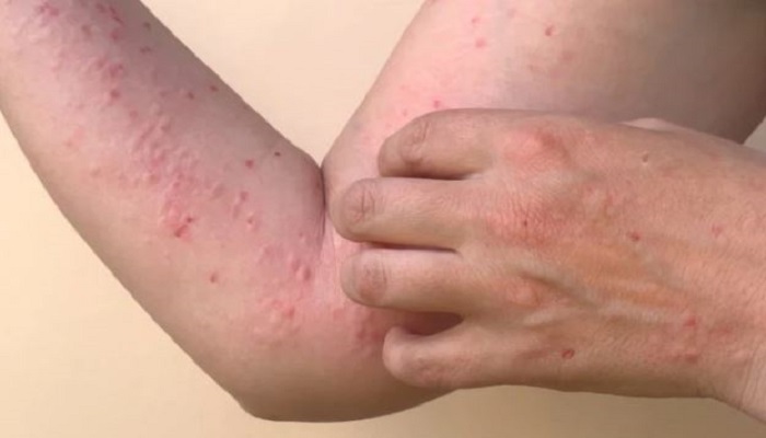 Pakistan confirms its first case of monkeypox of 2024