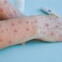 Pakistan reports second case of Monkeypox