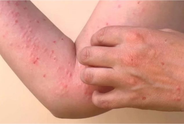 NIH issues health advisory about Chikungunya