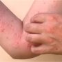 NIH issues health advisory about Chikungunya