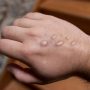 Pakistan reports first case of Monkeypox in 2025