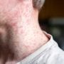 Measles cases surge in Karachi and Sindh
