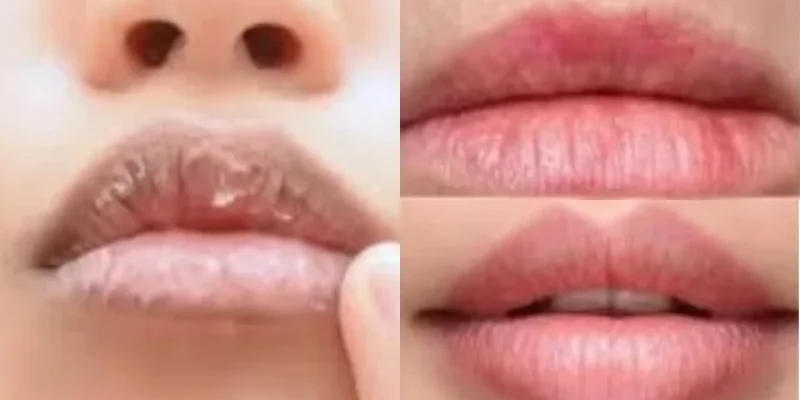 Cracked lips in Cold Weather? Doctors reveal the right care