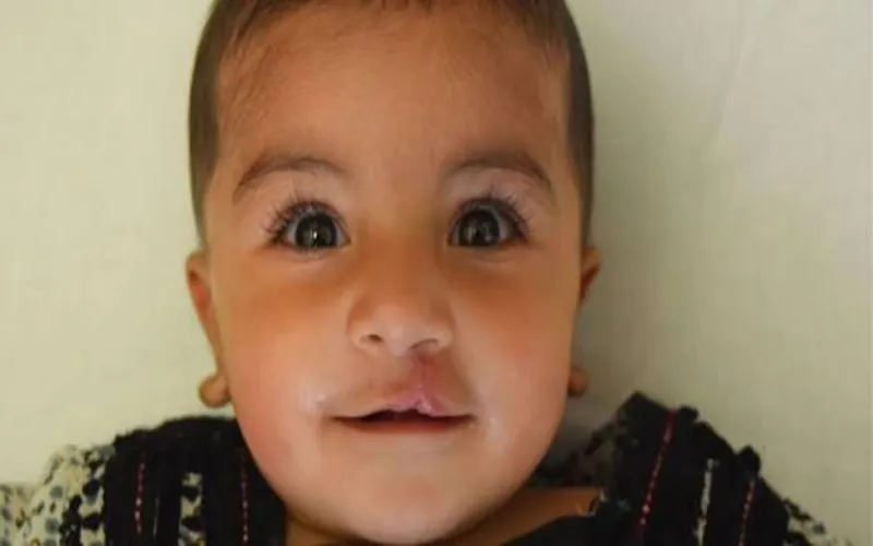 Thousands of Pakistani children still wait for cleft treatment