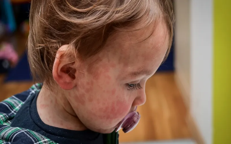 Measles outbreak in Sindh has led to the deaths of 53 children