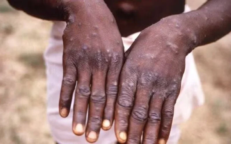 Another monkeypox