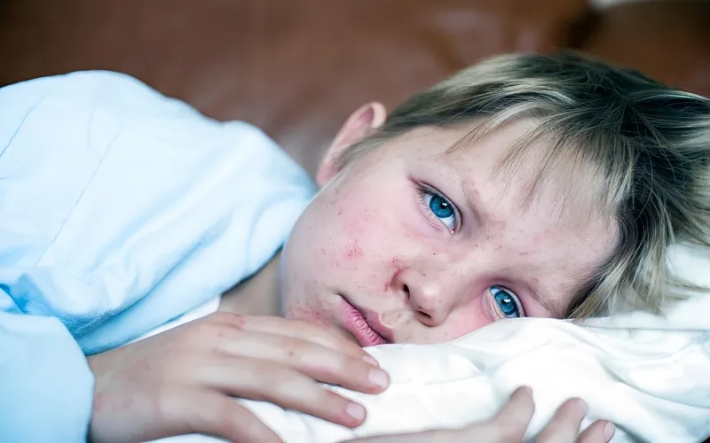 U.S. measles outbreak hits highest level in 35 years, CDC says